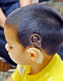 Implantes Cocleares